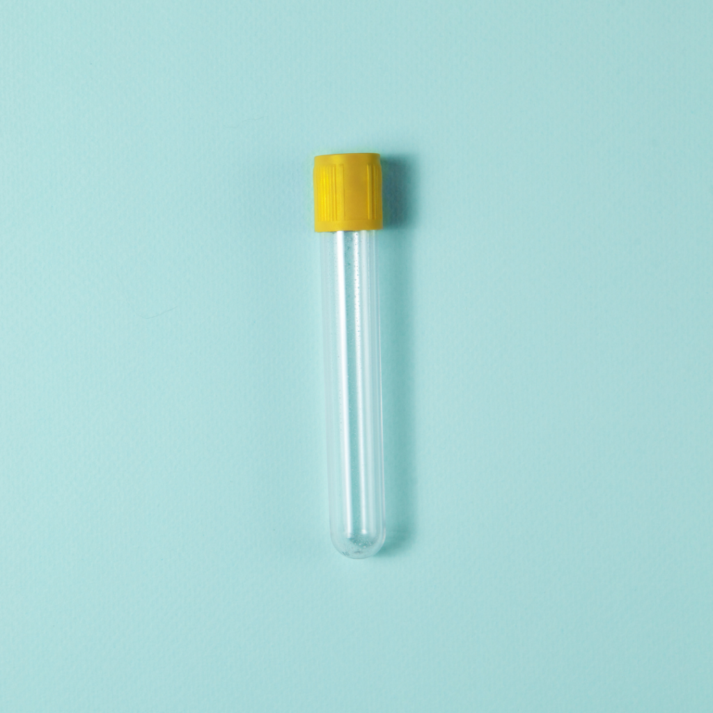 diabetes-mellitus-glucose-random-and-interpretation